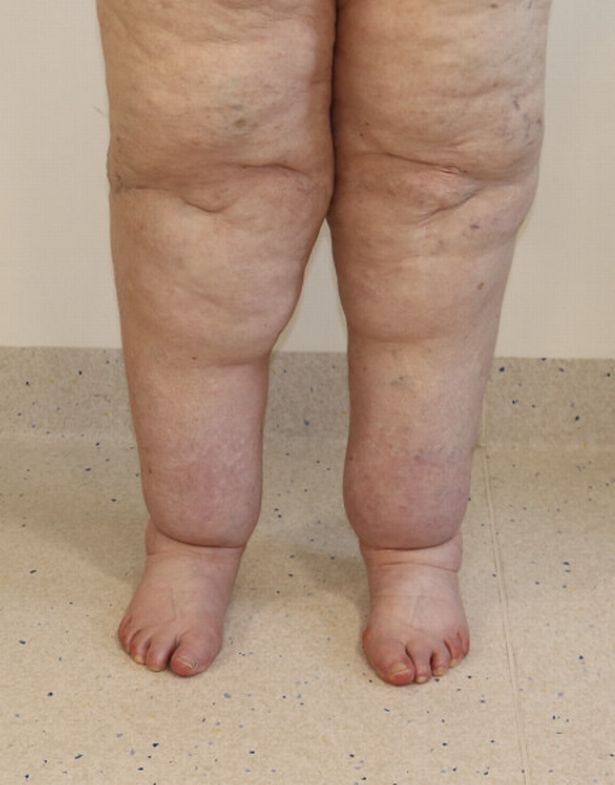 The <a href="/NHSuk/">NHS</a> withdrew funding for #lipoedema surgery yet former NHS surgeon Vasu Karri was so convinced by the need for help that he opened <a href="/thekarriclinic/">The Karri Clinic</a>: "I saw the effect this disease had on women &amp; thought 'this is something I want 2 do'."
hulldailymail.co.uk/news/hull-east… via @HullLive