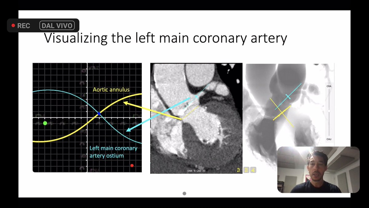 What an awesome lecture for every #IC at @MonteHeart by @nicolo_piazza on multi-modality imaging understanding like never coronaries and valvular position through Chamber Views and #Scurves. A lesson to see again and again youtu.be/Ktmi7gCrvqw Thank You very much! @azeemlatib
