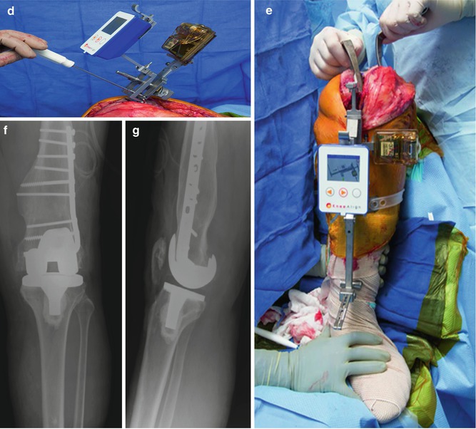 TKA navigation linked with increased survivorship, reduced systemic embolization risk: healio.com/news/orthopedi…