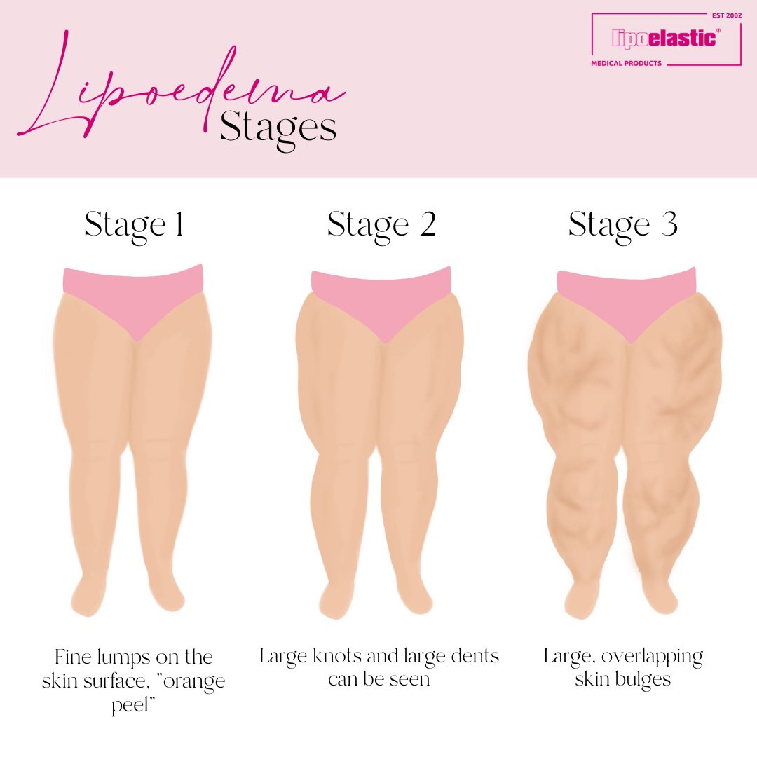 lipoelastic's tweet image. Get some basic insights about #lipoedema / #lipedema... 
•••
#lipoedemaawareness