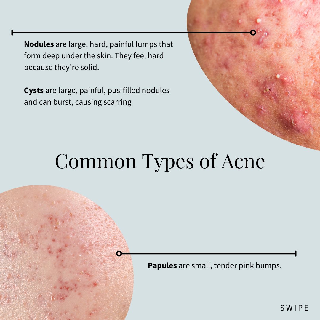 phylabiotics's tweet photo. In celebration of Acne Awareness Month, we wanted to bring awareness to different types of acne! It's important to identify what type of acne you may have in order to to best take care of your skin health. As always, be sure to confirm with your dermatologist. https://t.co/HtvU4vzNn0