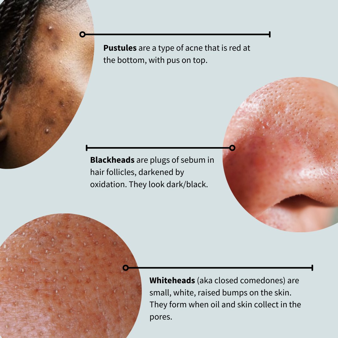 In celebration of Acne Awareness Month, we wanted to bring awareness to different types of acne! It's important to identify what type of acne you may have in order to to best take care of your skin health. As always, be sure to confirm with your dermatologist.