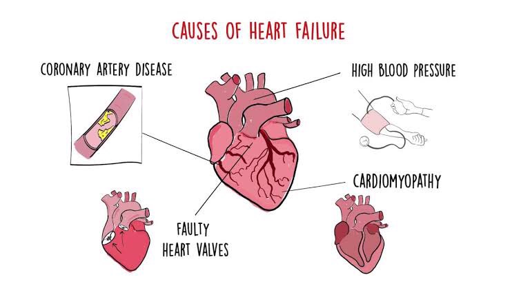 To the bottom of one heart. Heart failure. Сердечная недостаточность рисунок. Острая сердечная недостаточность рисунок.