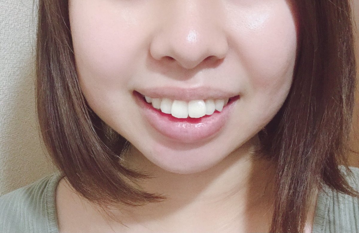 はる 歯列矯正とダイエット Harudaietto Twitter