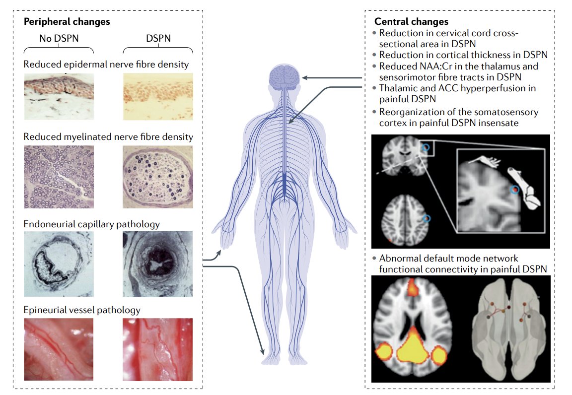 docramiro's tweet photo. Impresionante artículo de revisión sobre neuropatía periférica diabética publicado en Nature. Con lo último de lo último: https://t.co/NQ9269A5U8
#USMLE #ENARM #MIR https://t.co/Oh6fkS0SF4
