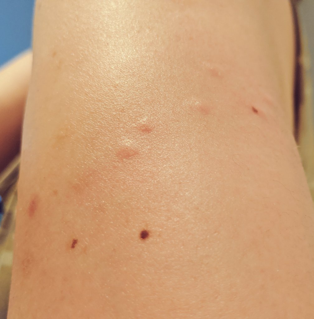 Raph 腕に虫が這ったような痒い赤いブツブツを発見したので 急いで犬の体をチェックしたら耳の付け根からおでこに同じような ブツブツが なんの虫よ ダニや蟻の様にしつこい痒みはなく 一度ムヒ塗ったら治まったから とりあえず犬にもムヒ塗っといた Raph 腕に虫が這ったような痒い赤いブツブツを発見したので 急いで犬の体をチェックしたら耳の付け根からおでこに同じような ブツブツが なんの虫よ ダニや蟻の様にしつこい痒みはなく 一度ムヒ塗ったら治まったから とりあえず犬にもムヒ塗っといた