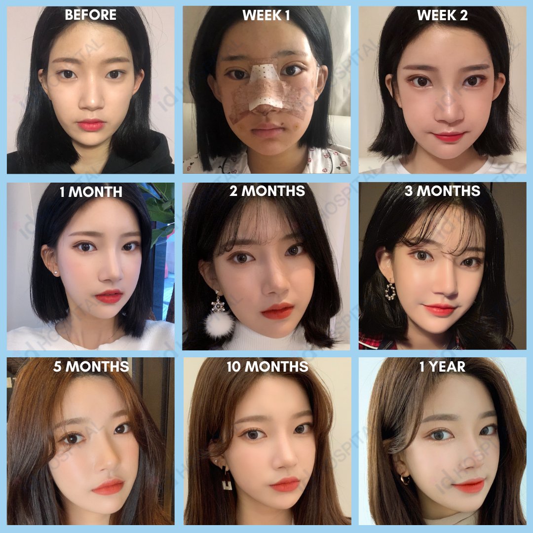 korean plastic surgery before and after jaw