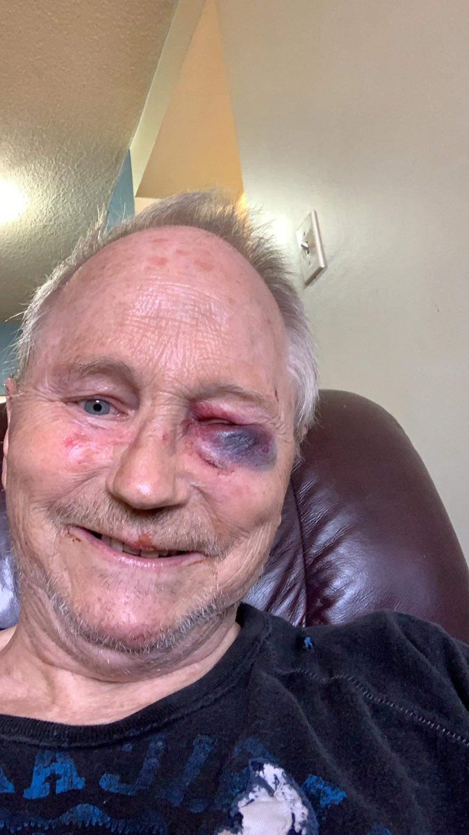 mikeDorosh1's tweet photo. I passed out twice last week, as he put me on serequel. They also push us down the mental health rod sone of these Drs- smashed 4 teeth 1 a front tooth, black and blue, cracked my nose,! good cut just below my knee, a big gash below my eye!! This is how we treat chronic pain🇨🇦 https://t.co/klVFZNVU8H