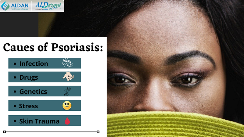 aldancare's tweet photo. Here Learn About Causes of Psoriasis... a skin disorder that causes skin cells to multiply up to 10 times faster than normal👇👇

#psoriasiswarrior #PsoriasisRelief #Psoriasis #psoriasisawareness #psoriasiscommunity #skindiseases #health https://t.co/ZGqgOxIIvs