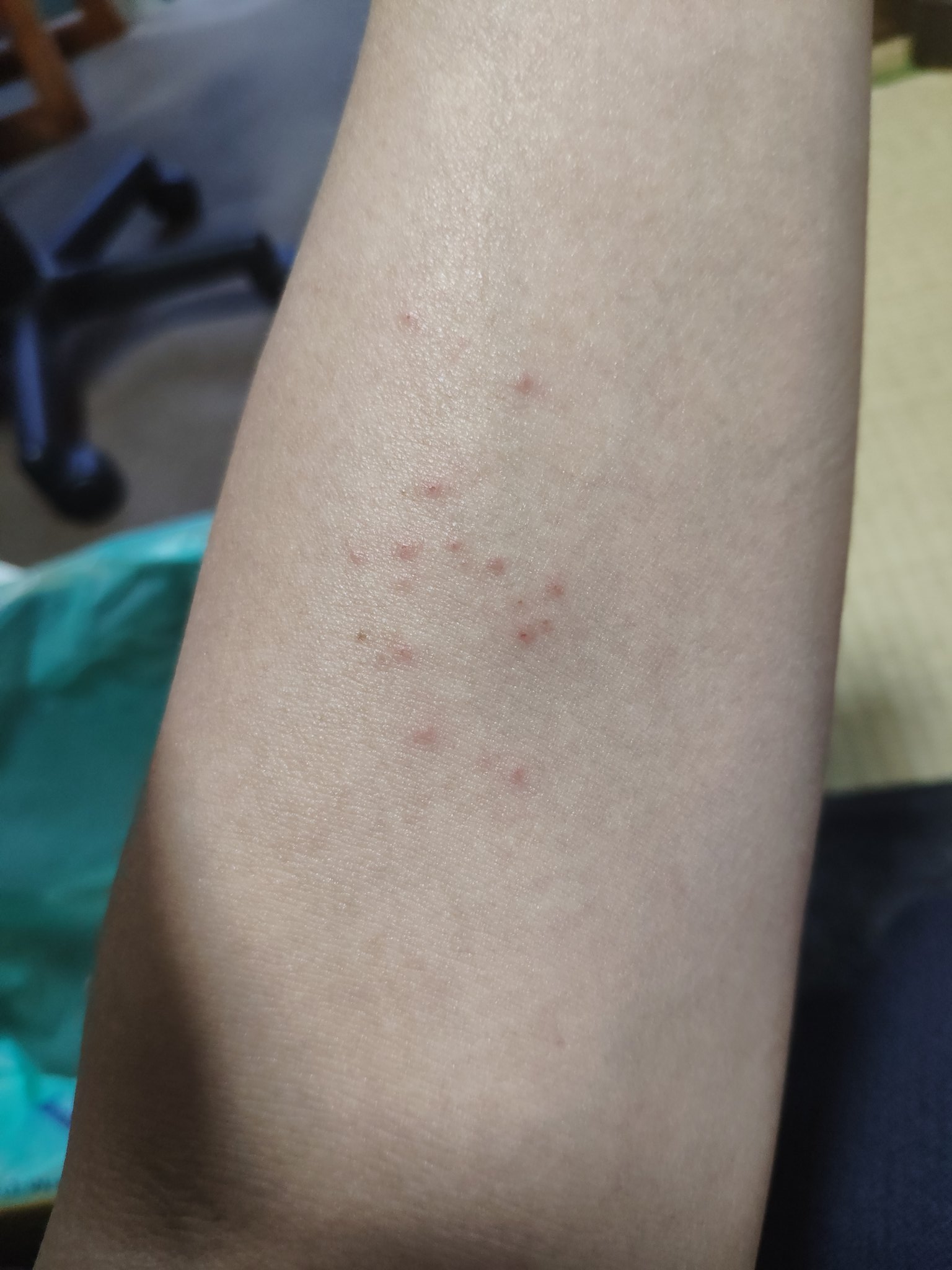 なかむらみつのり Jet 腕にブツブツが出来て痒くなり病院に行ったら チャドクガの毛虫に刺されてます と 言われた 全く触ったり刺された記憶がないのになぜ どうやら 奴らの針は風に飛んできても刺さるらしい 椿によくいるそうなので皆さんもこの