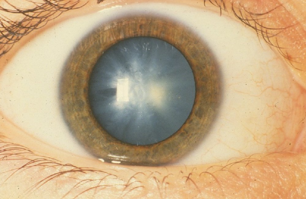 #Cataracts can develop from #aging, from an eye injury, or if you have taken certain medications. Cataracts may cause #blurredvision, #dulledvision, #sensitivitytolight & glare, or ghost images. If the #cataract interferes with your life, give us a call!
Photo Courtesy of @nihgov