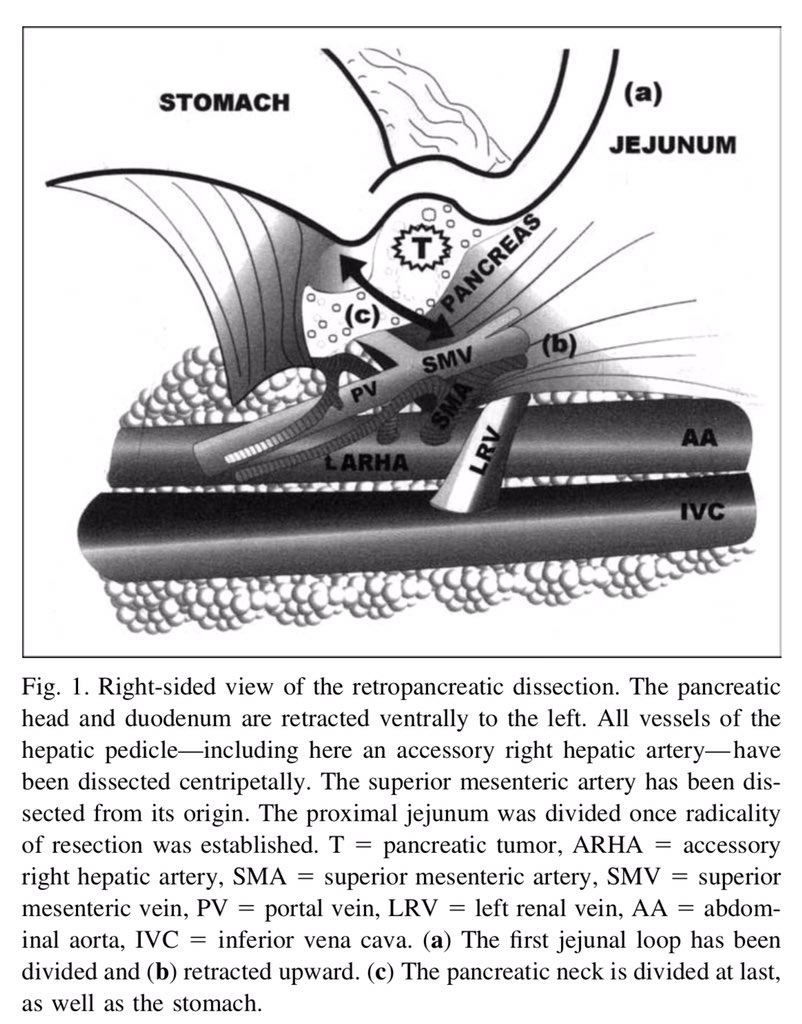 AmJSurgery's tweet photo. Early retropancreatic dissection during pancreaticoduodenectomy: How to do it ⤵️ #SoMe4Surgery @herbchen @pferrada1 @PipeCabreraV @cirbosque @SocietyofBAS @DChu80 @SWexner @juliomayol @MISIRG1 @WomenSurgeons @BrenessaL @DanaTelem @drdevirgilio https://t.co/5m9lqgf8vd