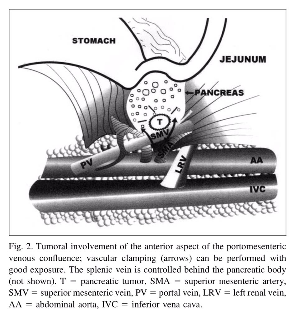 Early retropancreatic dissection during pancreaticoduodenectomy: How to do it ⤵️ #SoMe4Surgery <a href="/herbchen/">herb chen</a> <a href="/pferrada1/">Paula Ferrada MD FACS FCCM MAMSE</a> <a href="/PipeCabreraV/">Dr Luis Felipe Cabrera Vargas MD FACS</a> @cirbosque <a href="/SocietyofBAS/">Society of Black Academic Surgeons</a> <a href="/DChu80/">Daniel I-Hsin Chu | 朱以信</a> <a href="/SWexner/">Steven D Wexner MD, PhD</a> <a href="/juliomayol/">Julio Mayol</a> @MISIRG1 <a href="/WomenSurgeons/">WomenSurgeons</a> <a href="/BrenessaL/">Brenessa Lindeman, MD, MEHP</a> <a href="/DanaTelem/">Dana Telem</a> <a href="/drdevirgilio/">Christian de Virgilio MD FACS</a>