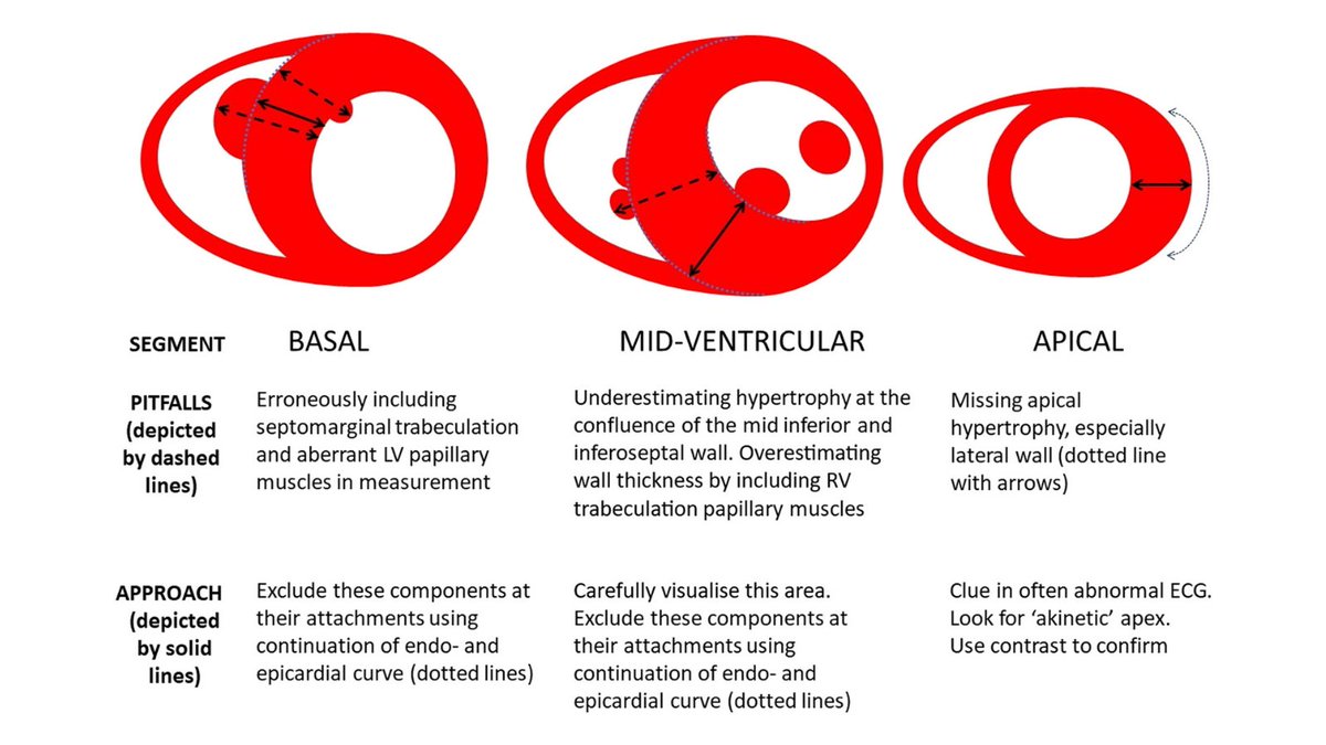 🚨 NEW GUIDELINE 🚨

We're delighted to announce the publication of our new #HypertrophicCardiomyopathy guideline - check it out here: erp.bioscientifica.com/view/journals/…
