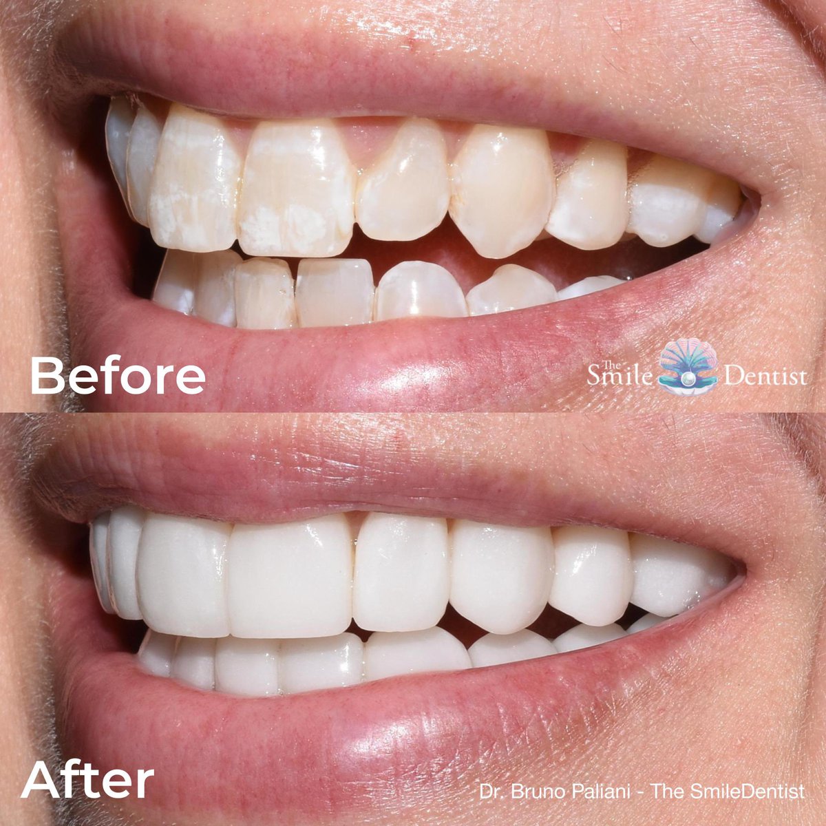 Ultra Thin Porcelain Veneers are a great way to improve your smile with no freezing, no drilling and no removal of sensitive tooth structure! Your new smile may be completed in just 2 quick appointments, 2-3 weeks apart!
Free Virtual Consultations:  virtualconsultforme.com/SmileDentist/C…