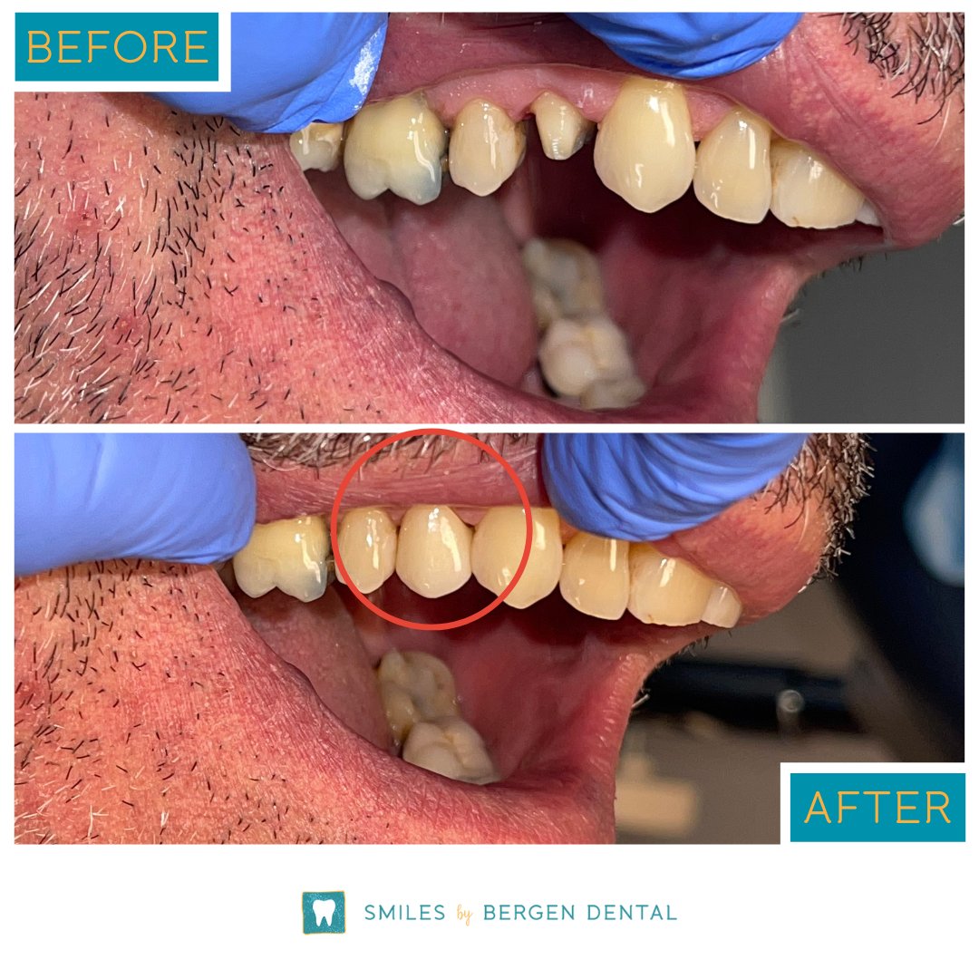 SmilesbyBergen's tweet photo. Let’s play find the crown!!!

This ceramic crown offers protection and aesthetics. A simple procedure helped this patient smile again. Click the link below to learn more. #SmilesbyBergen

https://t.co/kSNkINbFQu https://t.co/sXEsrCTo2V