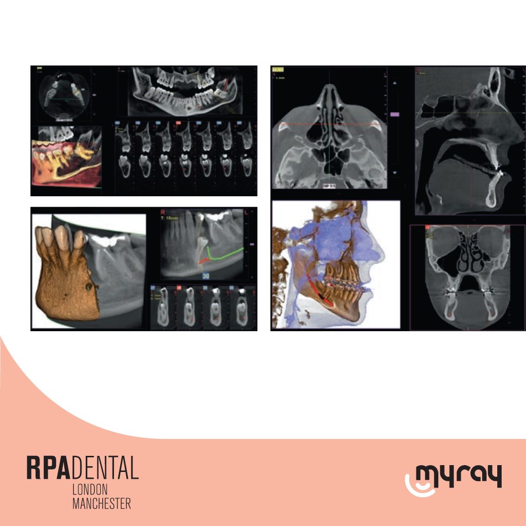 HyperionX9 pro 
Orthodontic applications

FOVs with a 10 cm diameter are essential for the study of impacted third molars because, in an adult of medium build,
 the distance between the third molars on the left and right, including the respective roots. #dentistry