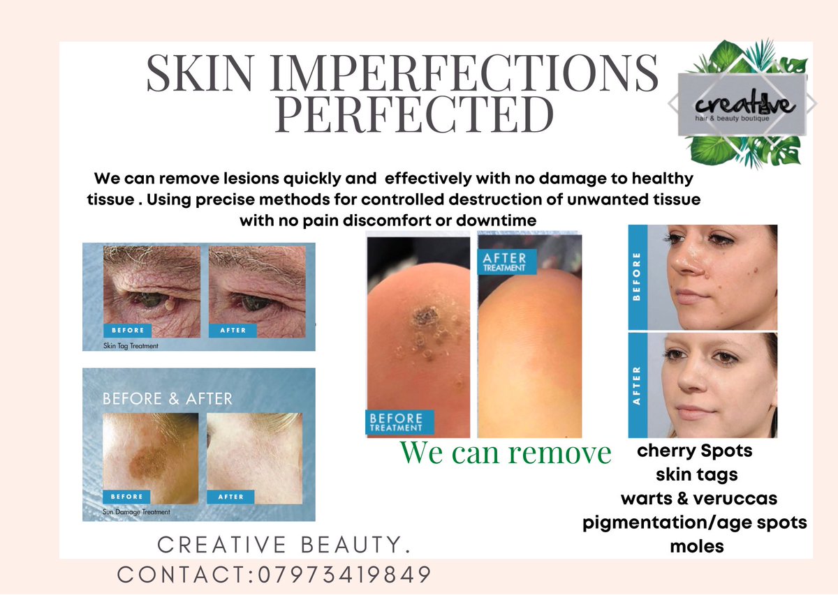 tracycreative's tweet image. We can safely remove skin tags , moles , veruccas , pigmentation , warts and cherry spots , with  our brand new treatments . They are frozen off , painless , safe and no downtime.  For details please private message #skin  #skintag #pigmentation #agespots #wartsremoval