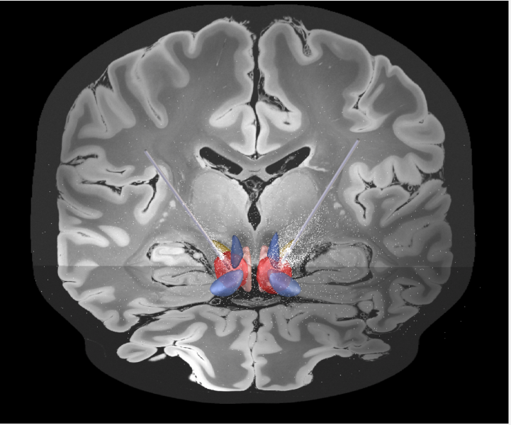 Electrodes implanted into the region of the brain involved in mediating sustained stress and anxiety © The University of Queensland.