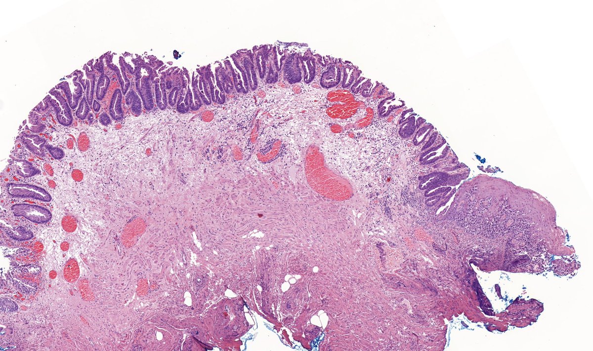 TristanRutland7's tweet photo. Anal verge, polyp

#GIpath #pathtwitter https://t.co/FOerMtmxQs