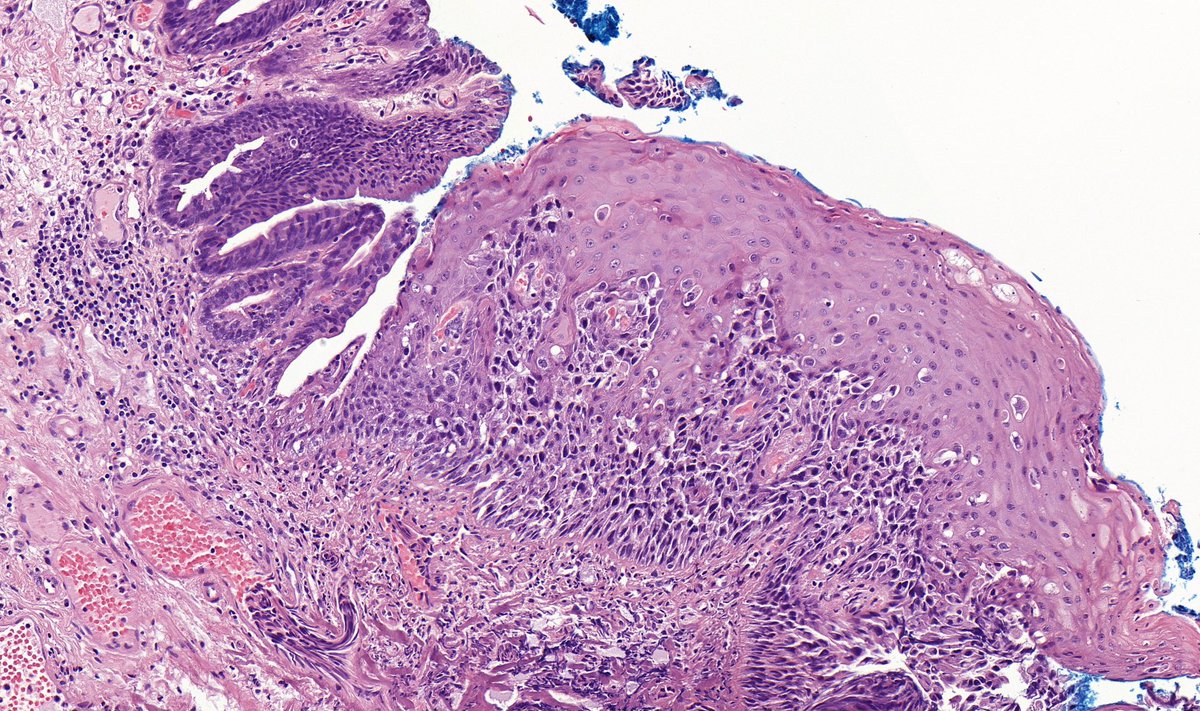 TristanRutland7's tweet photo. Anal verge, polyp

#GIpath #pathtwitter https://t.co/FOerMtmxQs