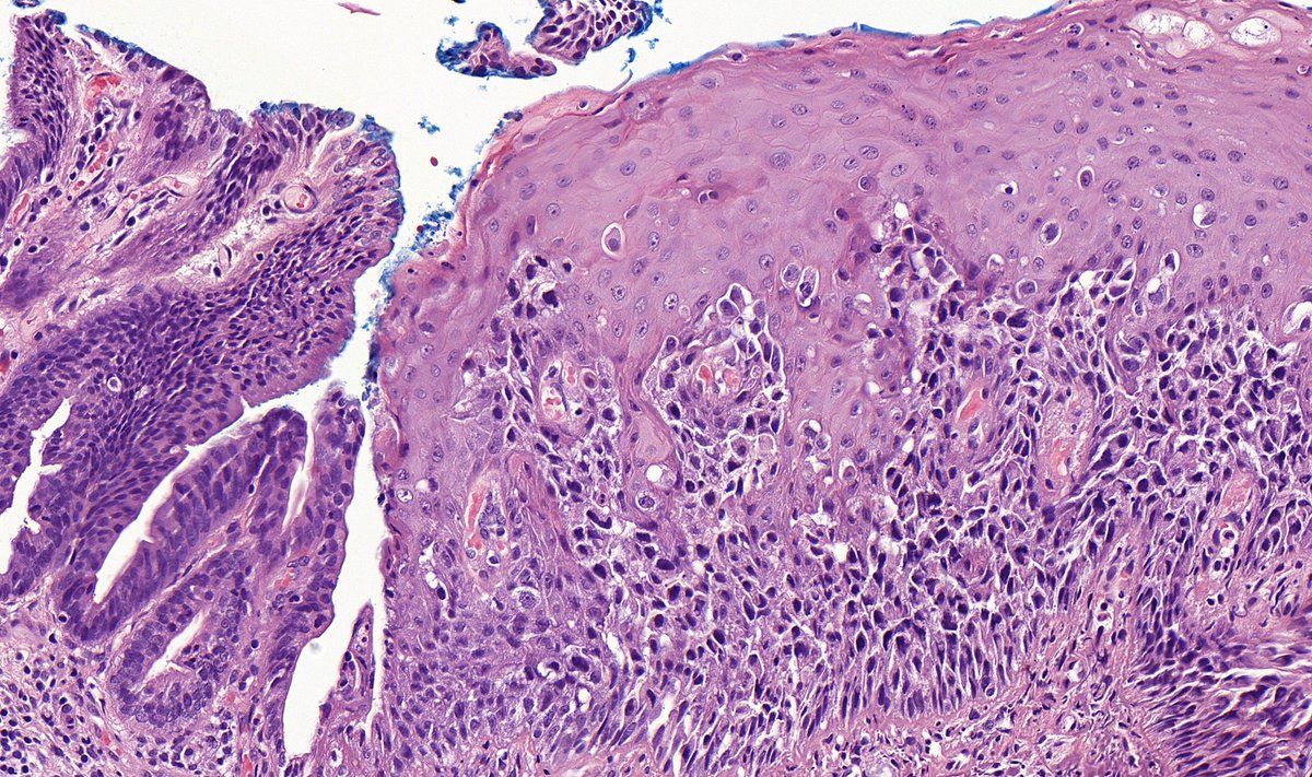 Anal verge, polyp

#GIpath #pathtwitter