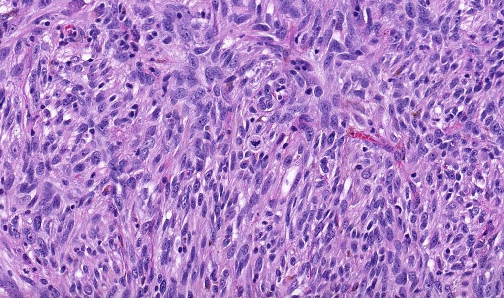 JMGardnerMD's tweet photo. 65 yo man with rapidly growing ulcerated black nodule on back. WSI digital slide:  
https://t.co/9gr4CNWTYX. Answer &amp; video here: https://t.co/Scgr7zZvR6. #BSTpath #pathology #pathologists #pathTwitter #dermpath #dermatology #dermatologia #dermtwitter https://t.co/trGNRl4oJm
