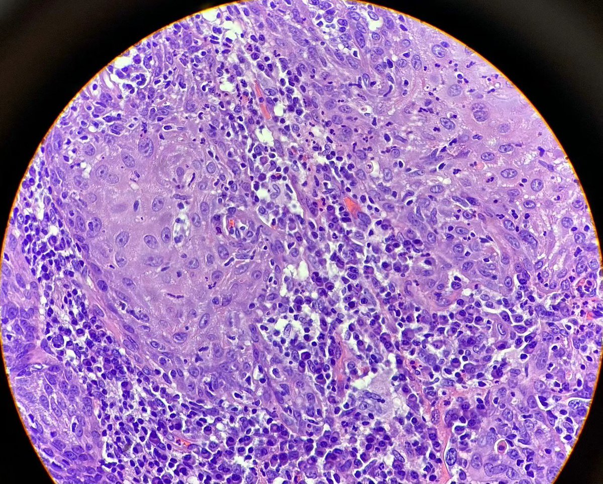 For all #dermpath lovers there, if you are fan of Elston book mnemonics, remember “here comes big green leafy veggies “ for PEH with Intraepidermal neutrophilic microabscess. Now female 30s, lesion on nose. Clinical r/o sarcoidosis. Case shared by my friend J-P Cai, MD. Thoughts?