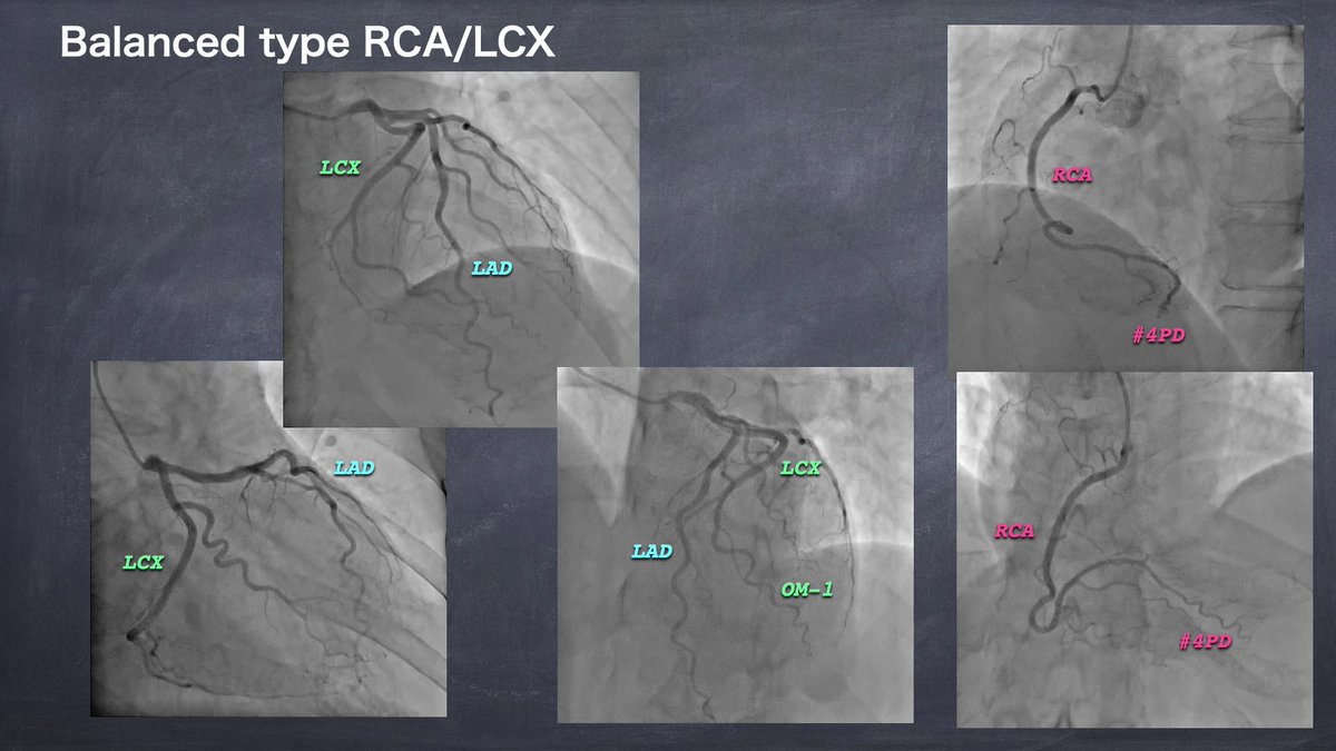 NaokiThukishima's tweet photo. #心電図検定試験 anatomy of coronary artery-10
症例-3:balanced type
RCAとLCXが、仲良く後下壁を灌流しております。
RCAは、#4PD 下中隔を。
LCXは、後壁までを。
LADは、少しだけ心尖部を巻き込んでいるようです。 https://t.co/48cHdium34