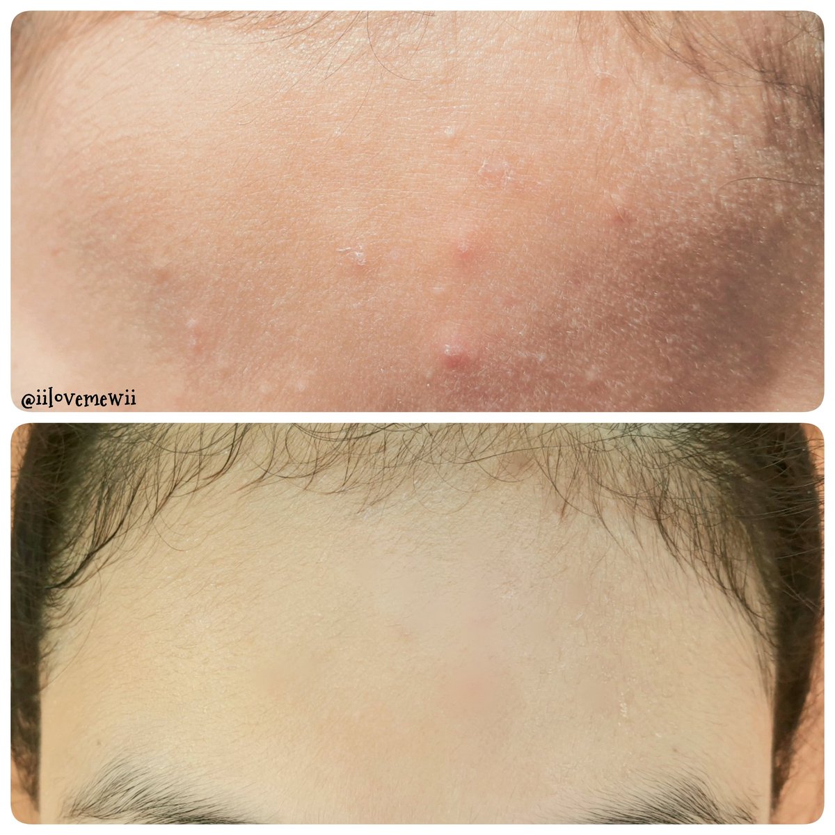 iilovemewii's tweet image. รอมานานมากในที่สุดก็ come back มาซะทีที่7-11 #เจลเซรั่มสิว ของ The Original Premium Cica Acne Serum Gel #ครีมซองลดสิว ซองเขียวๆแบบนี้ ช่วยดูแลผิวที่เป็นสิวให้แข็งแรงขึ้น ลดสิวลดรอย ใช้จนติดใจต้องตามหาน้องมาใช้ตลอดๆ ซองใหญ่อยู่เด้อซองละ 49฿.เท่านั้น ใครกลัวพลาดตุนจ้า #รีวิวเซเว่น