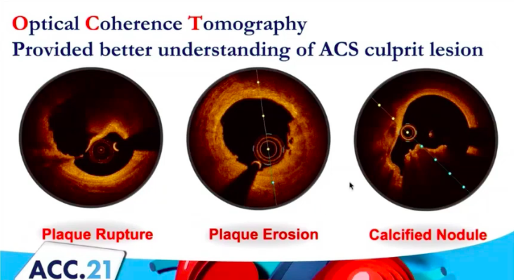 ACS Culprit Lesion