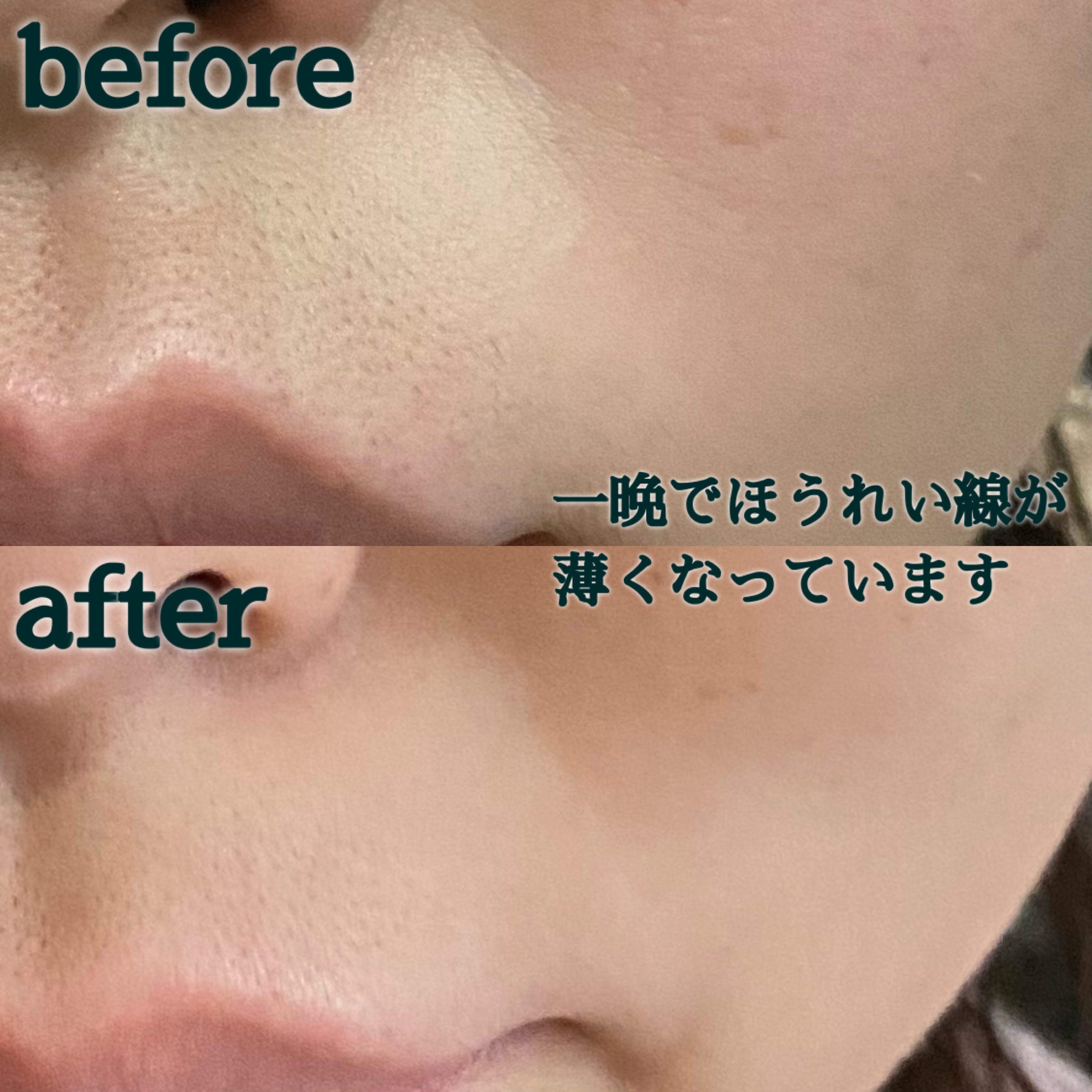 理奈 メイク垢 ほうれい線が秒で消えた 目元 ほうれい線美容液 後半 30代前半にオススメしたい 敏感肌でも使えたアンチエイジング美容液 フィルナチュ T Co Abqxeuis95 T Co 31qsp1zpz9 Twitter
