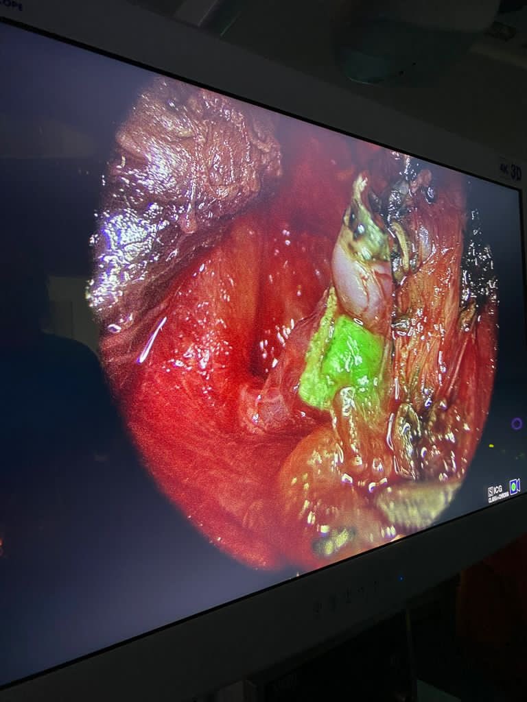 jaumebonninp's tweet photo. La #autofluorescencia paratiroidea ha venido para quedarse. Su aportación es innegable. Y sí, ya sabemos que no substituye al correcto estudio anatómico pero sus aplicaciones son diversas. @CrisAlvarezSe @MarinaJiSe @sobacir @cgdsonespases @SonEspases @CirEnd_AEC @storz_karl https://t.co/bDEFlvaVoO