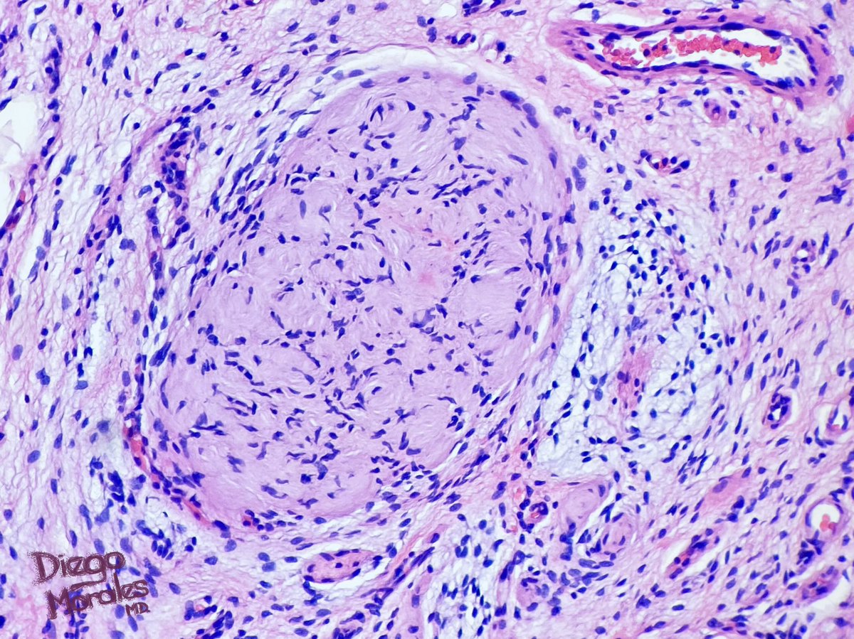 DiegoMoralesN's tweet photo. Meissnerian differentiation as a tale-telling feature for diffuse variant of neurofibroma.
📌mostly upper body
📌 associated with NF1 in ~20-30%
📌mostly young people
📌infiltrative-looking

#pathtwitter #dermtwitter #dermpath #stpath https://t.co/Sh0vPb3qdo