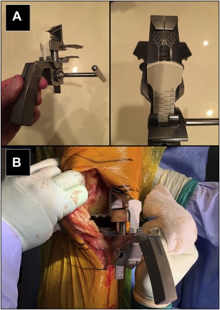 💥Sensitive Image💥
Posterior Cruciate Ligament Resection Does Not Consistently Increase the Flexion Space in Contemporary Total Knee Arthroplasty: arthroplastyjournal.org/article/S0883-…