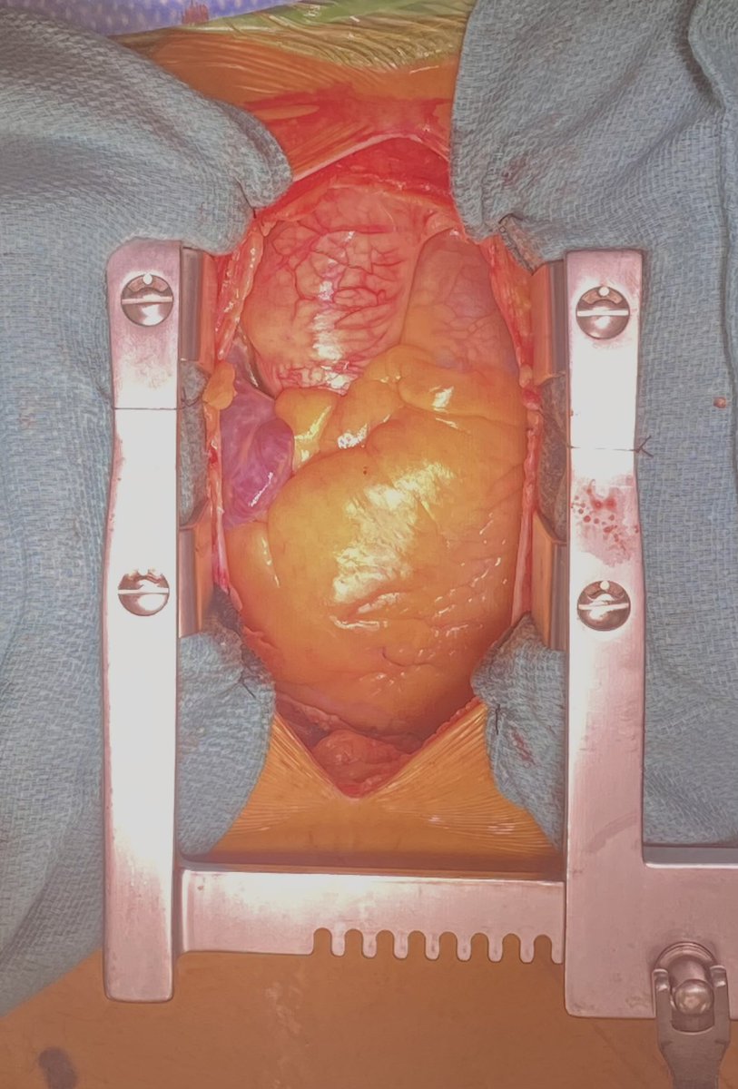 ifixhearts's tweet photo. This is poor metabolic health 

Visceral cardiac fat

Fix your metabolic health now or I will have this view of your heart in the future

#HeartHealth #Health #wellness https://t.co/yZnpB5sURl