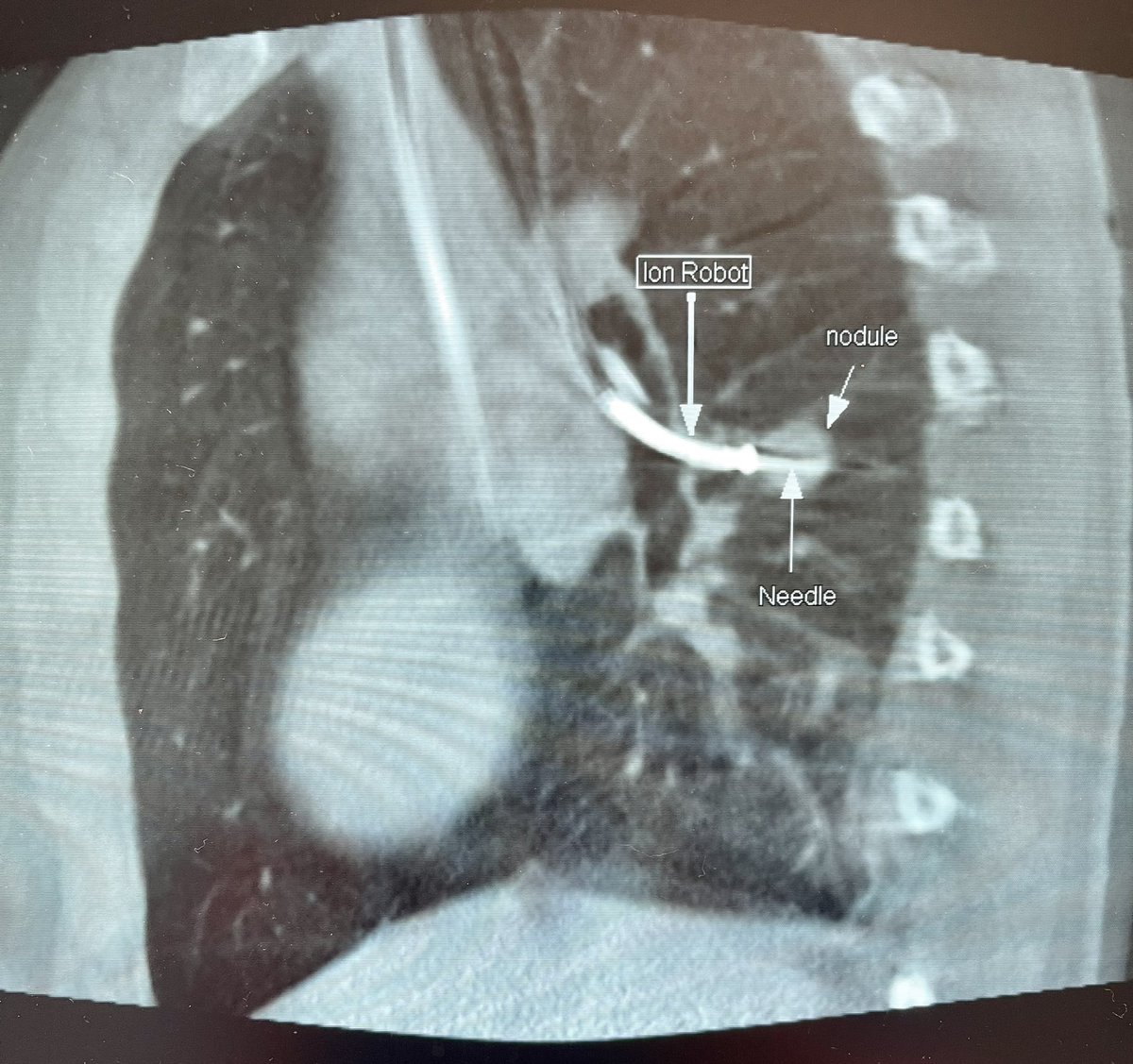 Bhadra & Condra CBCT Bronchoscopy tweet media