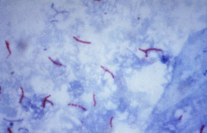 LidiaLeyton2's tweet photo. Te presentamos a la Mycobacterium Tuberculosis es la bacteria causante de la enfermedad infecciosa altamente extendida por el mundo, conocida como Tuberculosis Pulmonar.

Es estrictamente aerobia, por lo cual el órgano que infecta principalmente es el pulmón. 
#tuberculosis 
-MHA https://t.co/uqYqGEgtnA