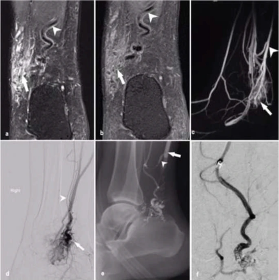 #Endovascular balloon-assisted liquid embolisation of soft tissue #vascularmalformations: technical feasibility and safety Read it free of charge: cvirendovasc.springeropen.com/articles/10.11… #irad #embolisation @JulianMaingard