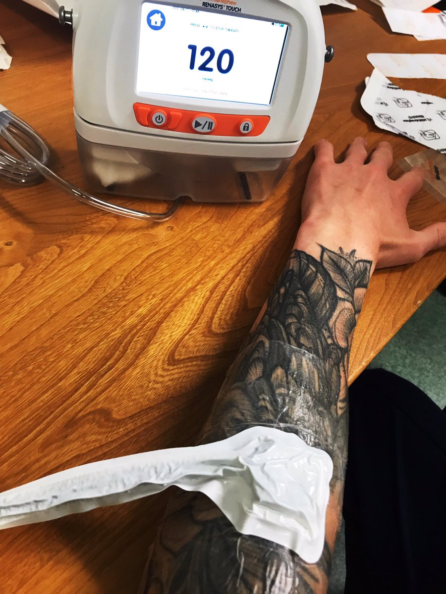 Some Topical Negative Pressure training this morning with <a href="/SmithNephewPLC/">Smith+Nephew</a>! I’m sure all wounds will be just as easy to dress as my forearm.. 🙃