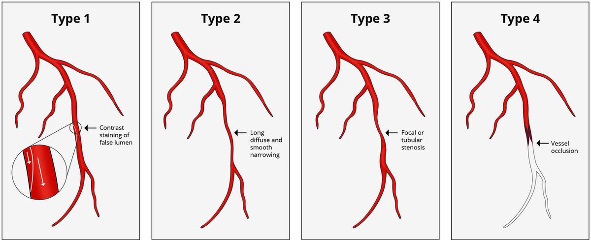 Spontaneous coronary artery dissection: to do good or to do no harm? ow.ly/ScFV50F4v9R