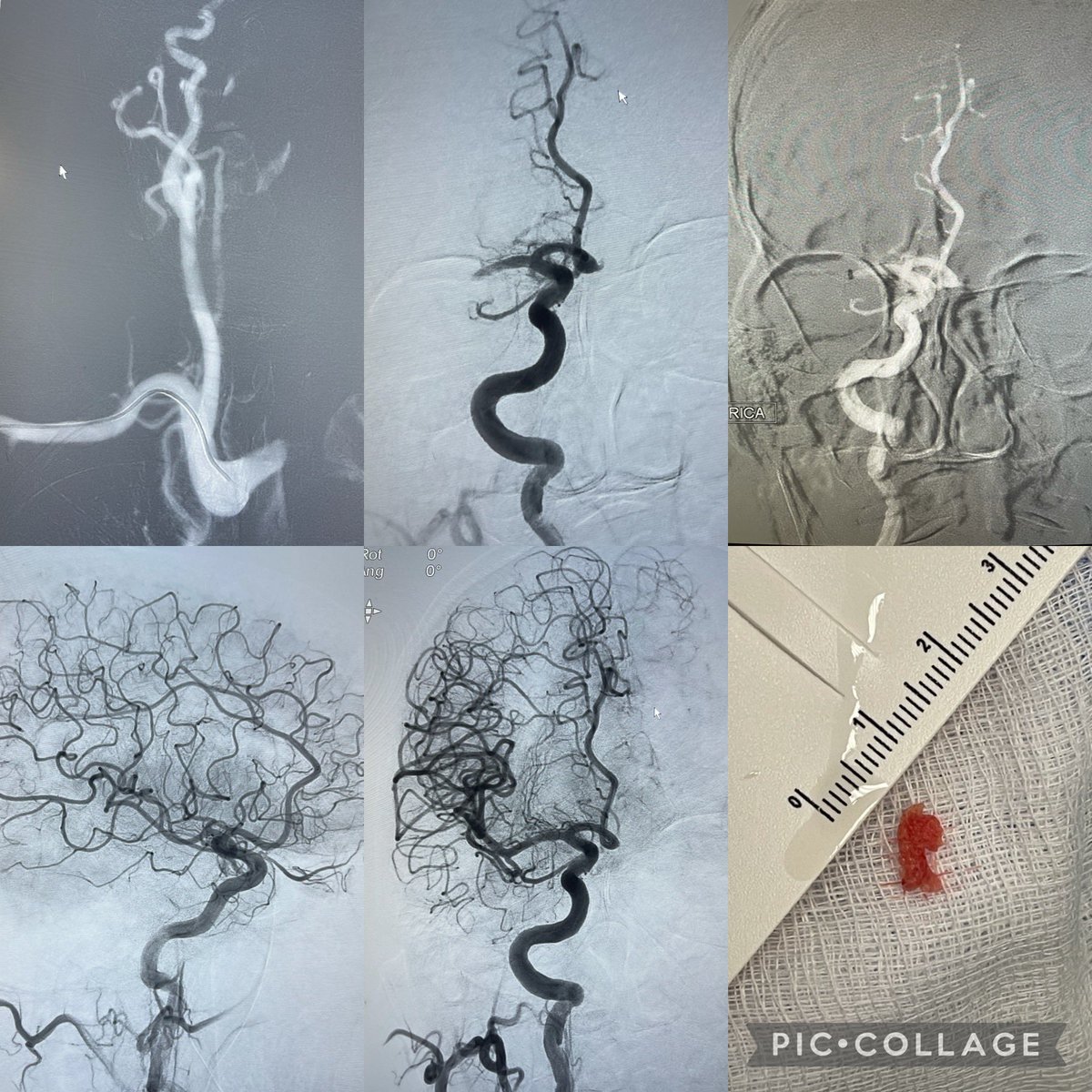 RLHINR's tweet photo. What’s better than M1 flow reversal, #TICI3 and a patient improving their #stroke score on the table? Going #radialforneuro in a type 3 arch. INR 1.9 and in AF but the patient embolised this fibrous clot. Short work made of it by #Millipede088. @BThrombectomy @RoyalLondonHosp https://t.co/VWKue45PFp