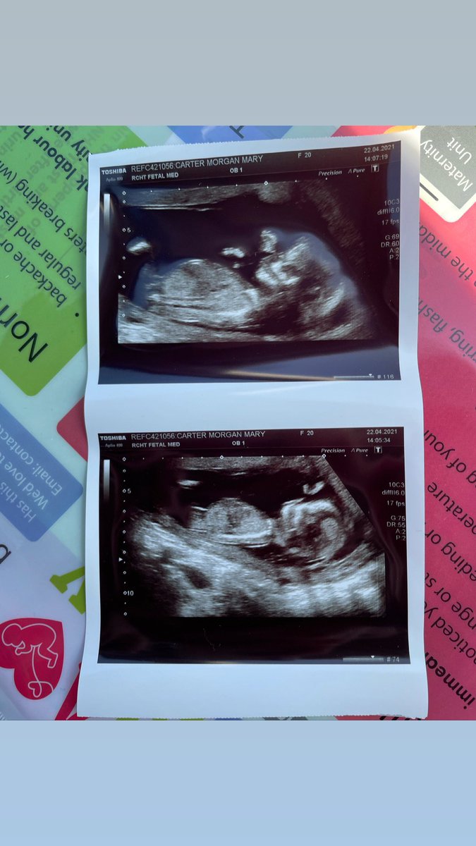 MorganPUNC19's tweet photo. I can not believe I forgot to post on here! Lewis and I are expecting our first baby a little BOY - October 2021💙#Pregnant #Pregnancy #Expecting #Firstbaby #Boy #October2021 #21Weeks #Firsttimeparents https://t.co/Ar7agfeVDO