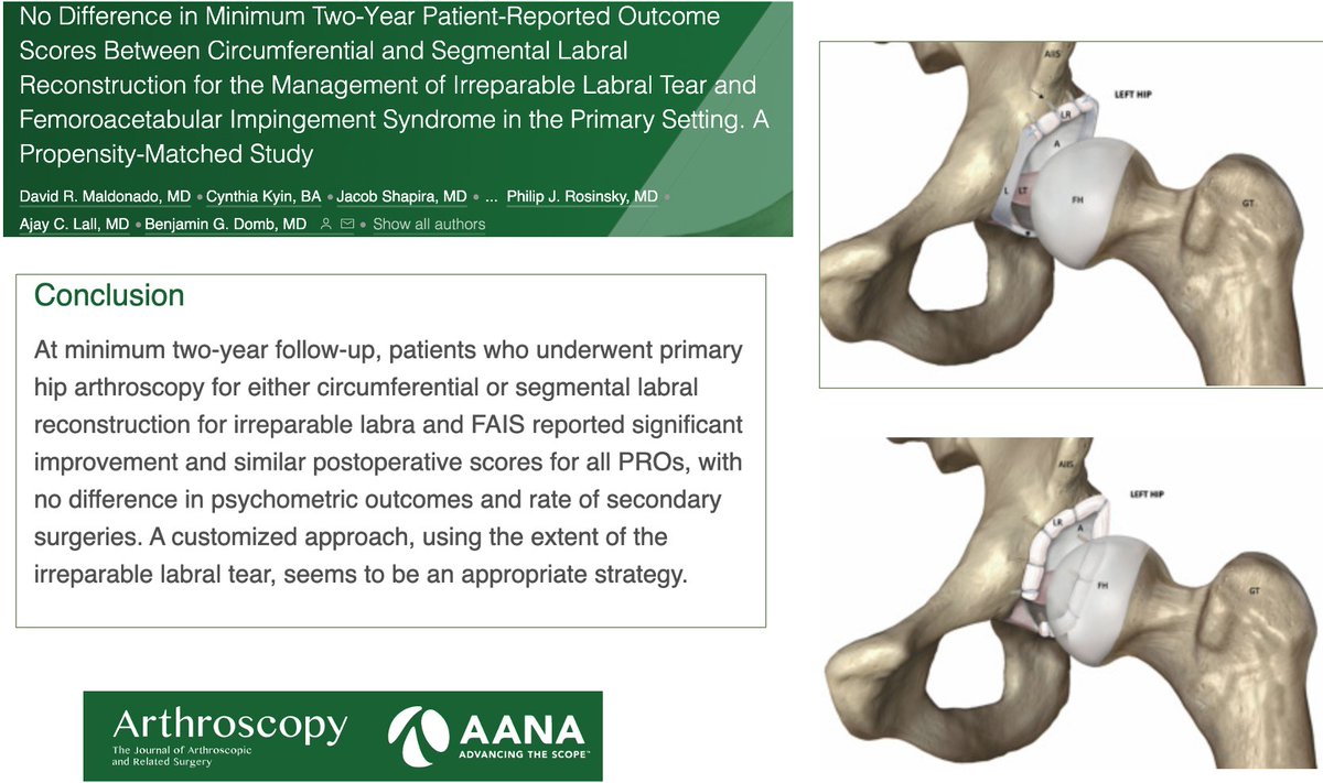 ArthroscopyJ's tweet photo. Either circumferential & segmental #labralreconstruction for primary #hiparthroscopy in the setting of #FAI & irreparable #labraltears at minimum two-year FU leads to significant and comparable outcomes improvement
https://t.co/sJEkXvxmRE
@MaldonadoMD_
@BenjaminDombMD https://t.co/Rgmyg7TjFb