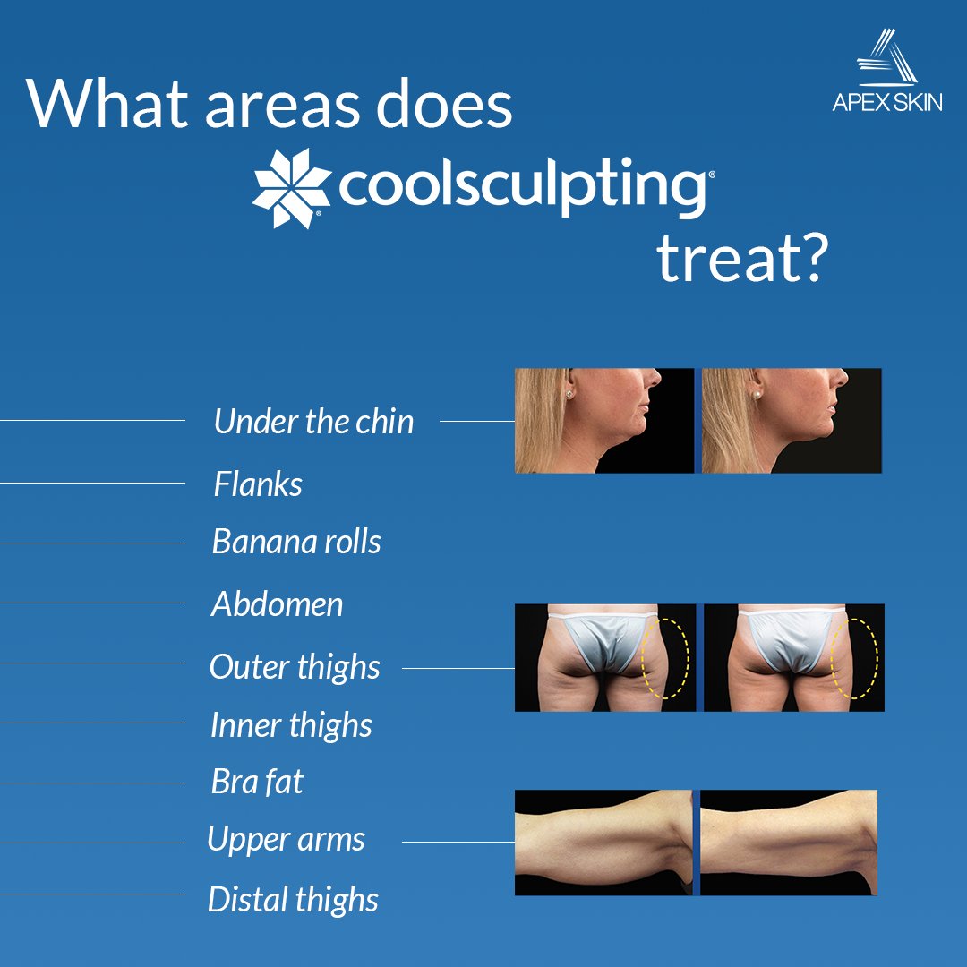 Are any of these areas giving you trouble? Come in for a complimentary consultation and let's see if we can help! ❄️

#freezeitfriday #coolsculptingpro #coolsculptingspecialist #cleveland #apexskin