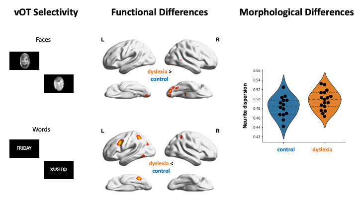 vborghesani's tweet photo. I’m an anterior temporal lobe girl, but I’ll never pass on a chance to look at language-related multimodal data! Our attempt to study the relation between reading behaviour, vOT word tuning &amp; neurite organization is online https://t.co/UE2l3d9oMH #dyslexia #vwfa #NODDI https://t.co/VzgZYSqxR6