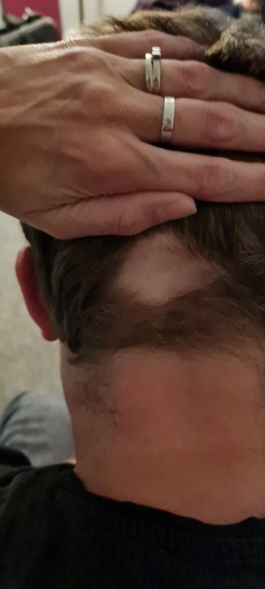youthworkermike's tweet photo. Stress induces eczema on my feet and alopecia on my head. Literally stressed head to toe at the moment #grossalert https://t.co/D4TOe66cLY