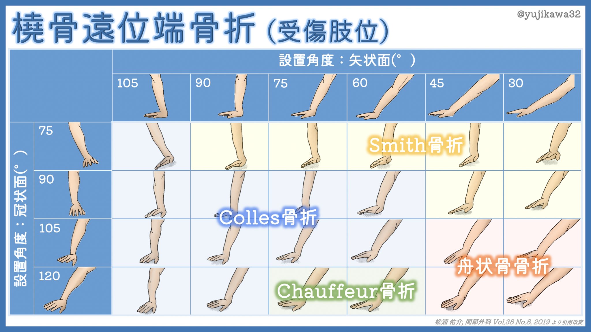 ユジカワ 整形dr イラストレーター 橈骨遠位骨折についての面白い研究を紹介 特にsmith骨折 掌側転位型 なんてどうやって起こるの と疑問だったので かなり勉強になった 34本も手を書いたことも評価してほしい 笑 橈骨遠位端骨折 イラスト日記