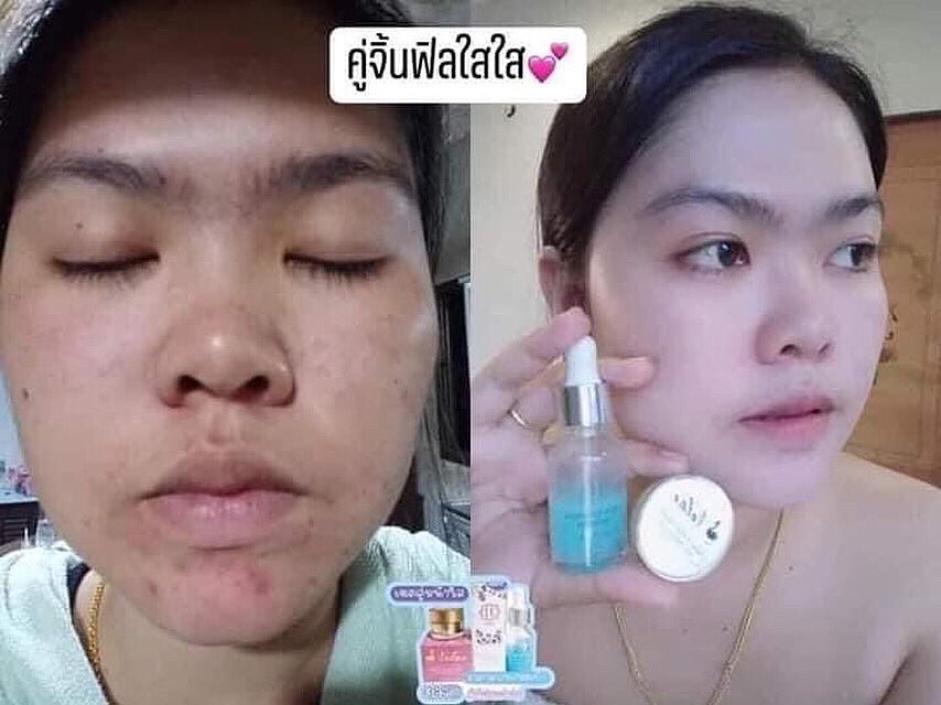 MikellShop's tweet photo. ก่อนหน้านี้คือหน้าพังมาก
หน้าสวย ใส ได้ด้วยเซตคู่ตัวนี้เลย 😱😊

#เนเต้ไนท์ครีม #เซรั่มไฮยา 
ดีจริงต้องลอง 🥰💦
#ครีมหน้าใส #ครีมรักษาสิว #ฉันจะสวย #หน้าใสไร้สิว #ถูกและดีบอกต่อ #ครีมหน้าขาว #ครีมบำรุงผิวหน้า #howtoperfect  #ฉันจะขาวฉันจะสวย 
#ครีม #ถูกและดี #ตัวแทนจำหน่าย https://t.co/Cj8SmPzdNp