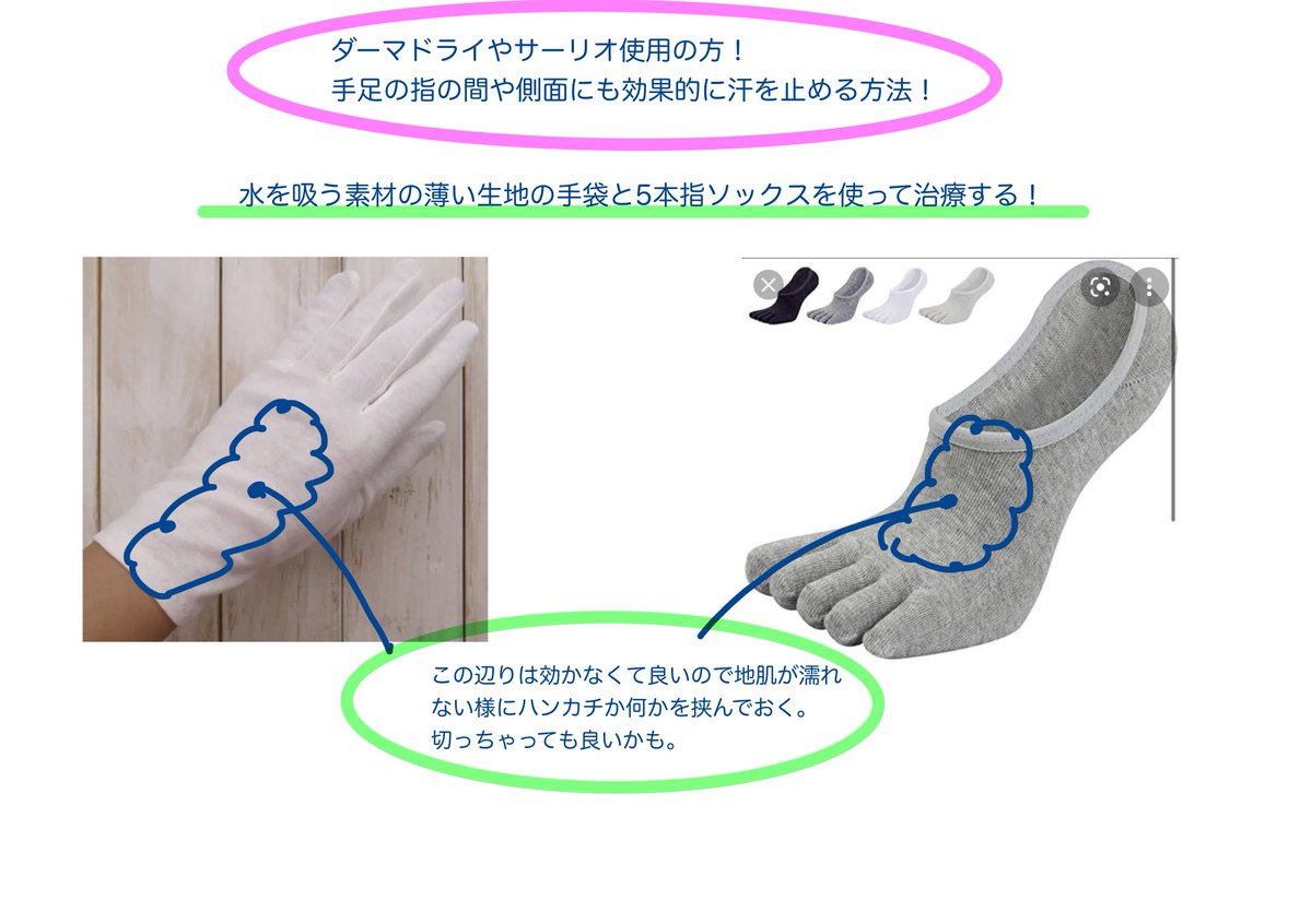 chiru_sweatman's tweet image. ダーマドライやサーリオを使っている多汗症の皆さん！
指の間や側面は汗止まらないでしょ？

こうすれば良いんです！超簡単！

水を吸う、薄い生地の手袋と5本指ソックスのまま治療すればOK！

これで指の間や側面の汗も止まります！
みんな試してみて！拡散して！サラサラになって！

(1/2)